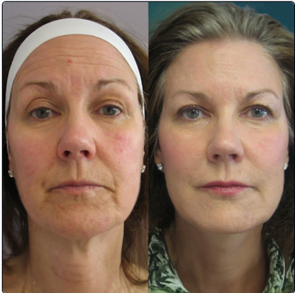 Nutrilofie Moisturizer