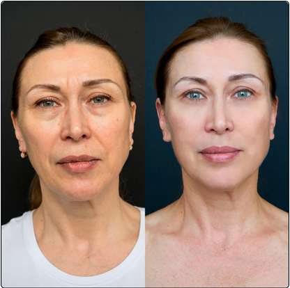 Nutrilofie Moisturizer